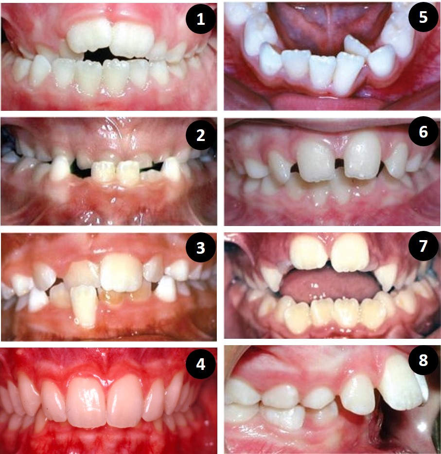 Anomalies dentaires - orthodontie enfant