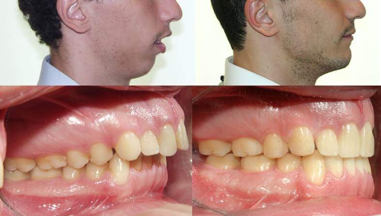 Cas de retrognathie en orthodontie adulte