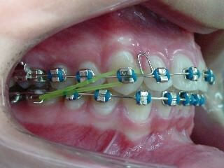 Traitement orthodontique en tractions inter-maxillaires (élastiques dentaires)