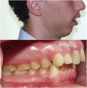 Orthodontie adulte patient rétrognathe (menton fuyant)