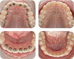 orthodontie adulte - traitement en orthodontie linguale paris