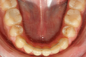 appareil dentaire de contention fixe