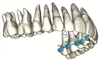 Orthodontie de pointe - Brackets Suresmile
